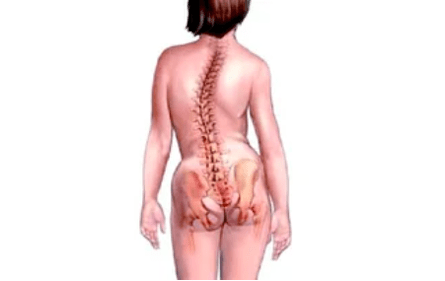 raisons du développement de l'ostéochondrose cervicale