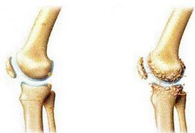 arthrose articulaire et articulaire saine