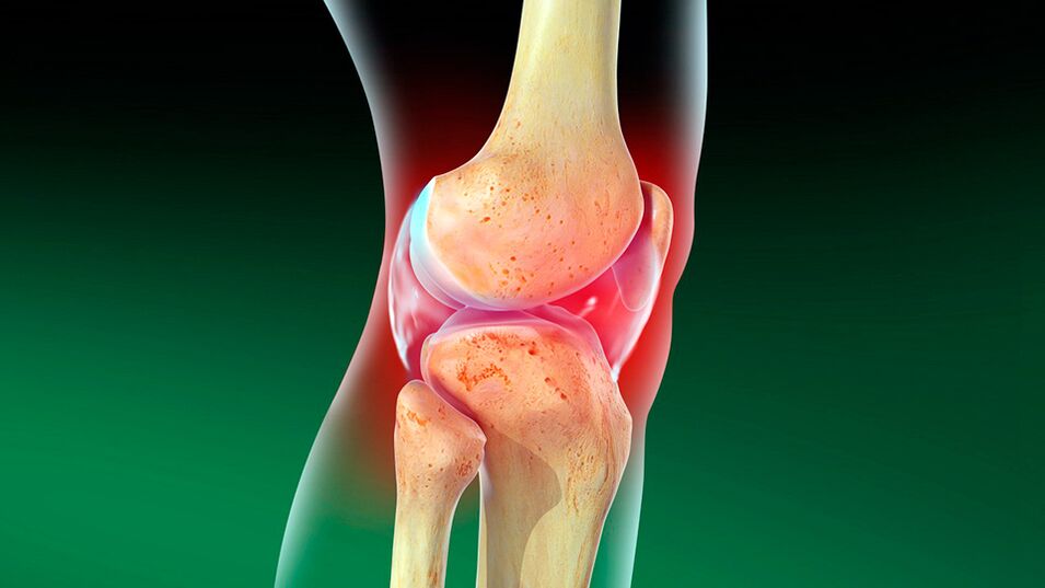 Arthrose de l'articulation du genou