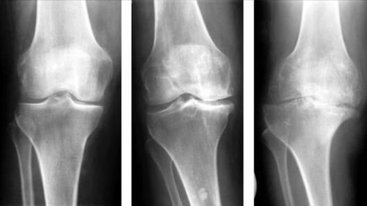 3 stades d'arthrose de l'articulation du genou