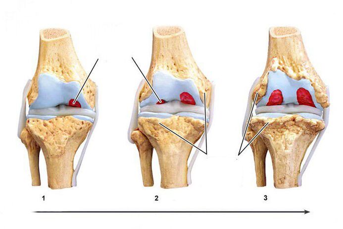 degré de développement de la gonarthrose